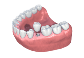 implant dentist