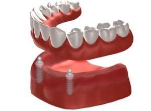 implant denture burtonsville md