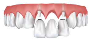 implant specialist
