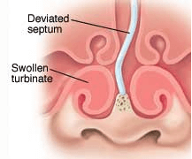 Deviated Septum