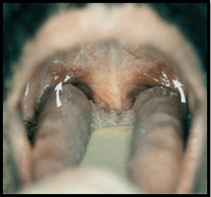 Long Soft Palate