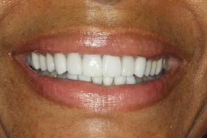 porcelain crowns after