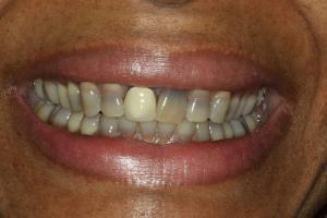 porcelain crowns before