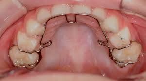 best palatal expander