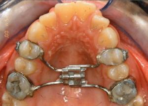 rapid palatal expander vs ALF