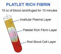 PRF platelet rich fibrin dentist