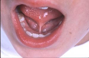 what causes tmj