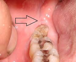 Wisdom Tooth Remol Normal Healing Images - voperbloom