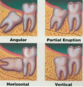 impacted wisdom tooth removal