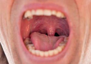 TMJ disorder symptoms